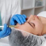 Microagulhamento e peeling