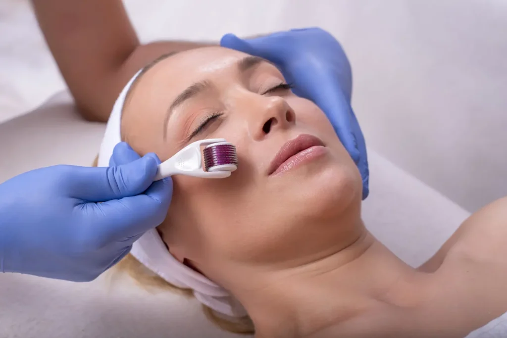 Mulher aproveitando os benefícios do microagulhamento, enquanto esteticista aplica dermaroller no seu rosto.