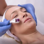 Mulher aproveitando os benefícios do microagulhamento, enquanto esteticista aplica dermaroller no seu rosto.