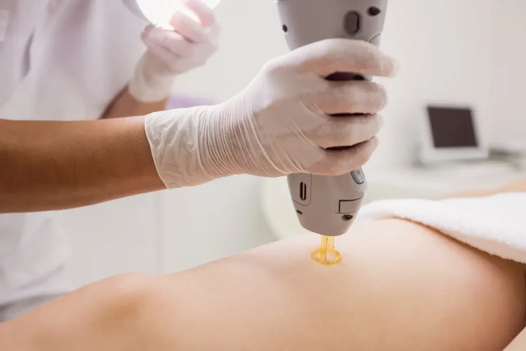 Paciente em clínica de estética passando por fotobiomodulação com aparelho laser na perna.