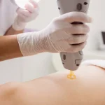 Paciente em clínica de estética passando por fotobiomodulação com aparelho laser na perna.